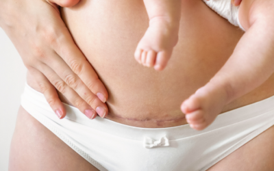 Fødsel ved kejsersnit